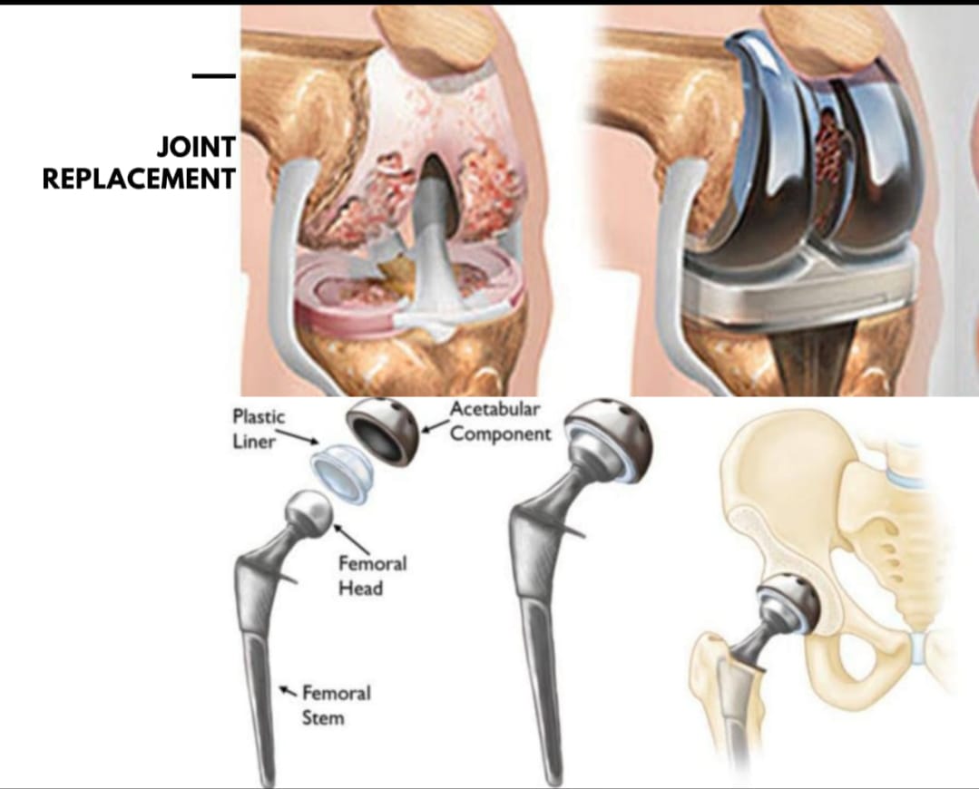 KNEE & HIP JOINT REPLACEMENT